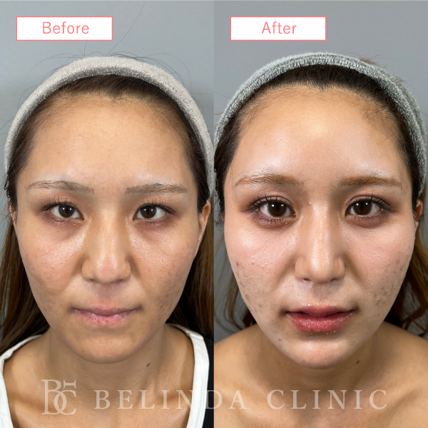 鼻尖縮小・鼻尖形成症例case02