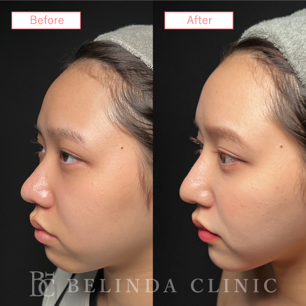 鼻プロテーゼ症例case03