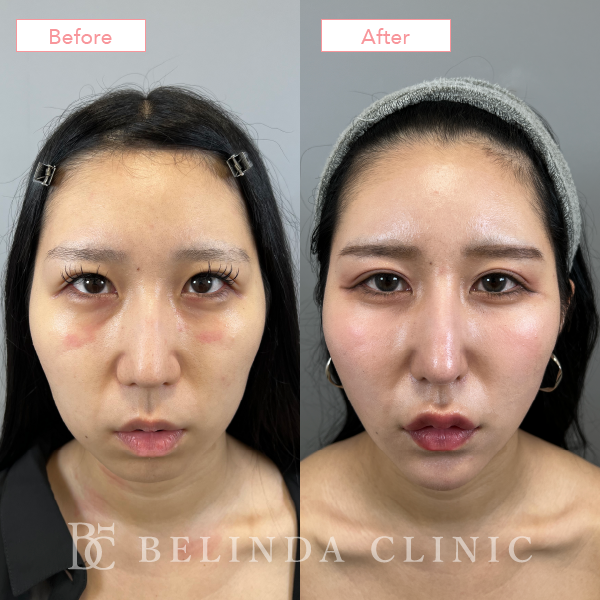 鼻尖縮小・鼻尖形成症例case11