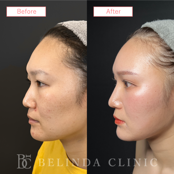 鼻プロテーゼ症例case04