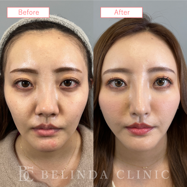 鼻尖縮小・鼻尖形成症例case05