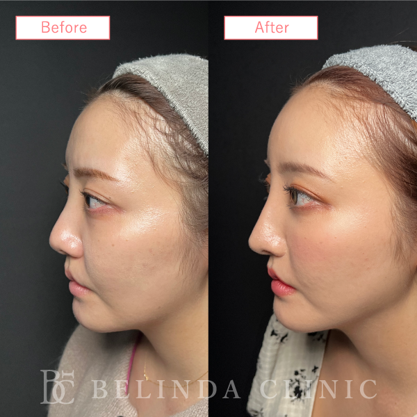 鼻プロテーゼ症例case05