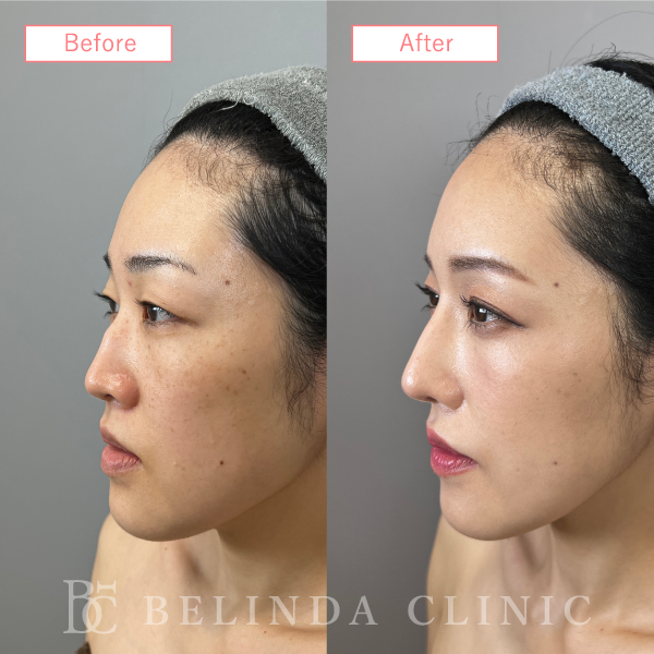 鼻プロテーゼ症例case06