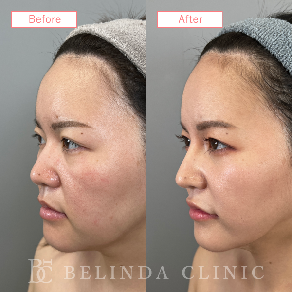 鼻プロテーゼ症例case07