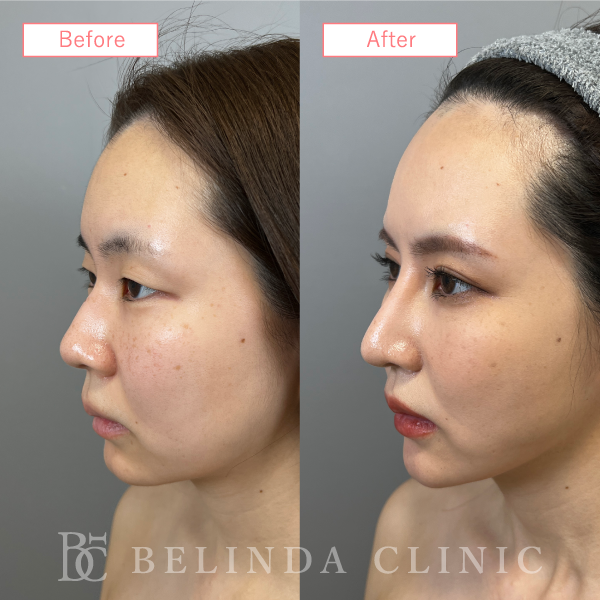 鼻プロテーゼ症例case08