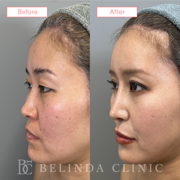 鼻プロテーゼ症例case10