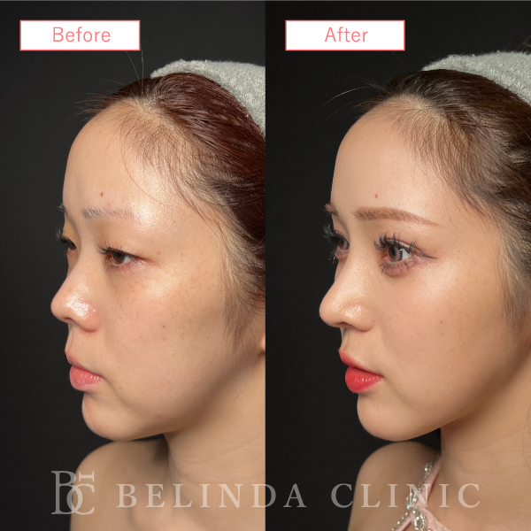 鼻プロテーゼ症例case11