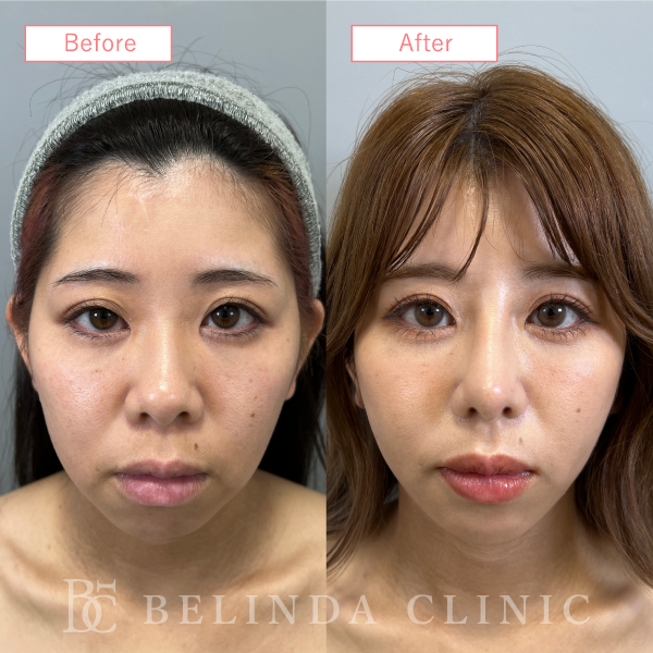 鼻尖縮小・鼻尖形成症例case13