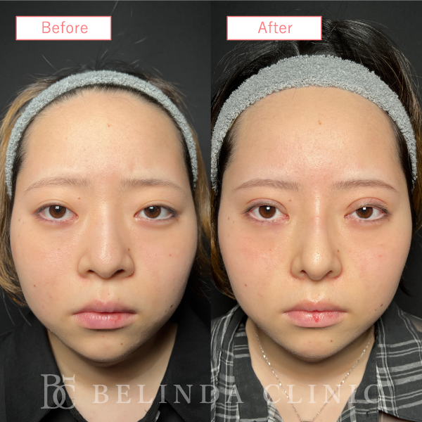 鼻プロテーゼ症例case12