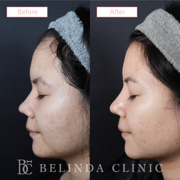 鼻プロテーゼ症例case13