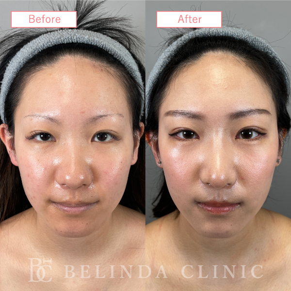 鼻プロテーゼ症例case14