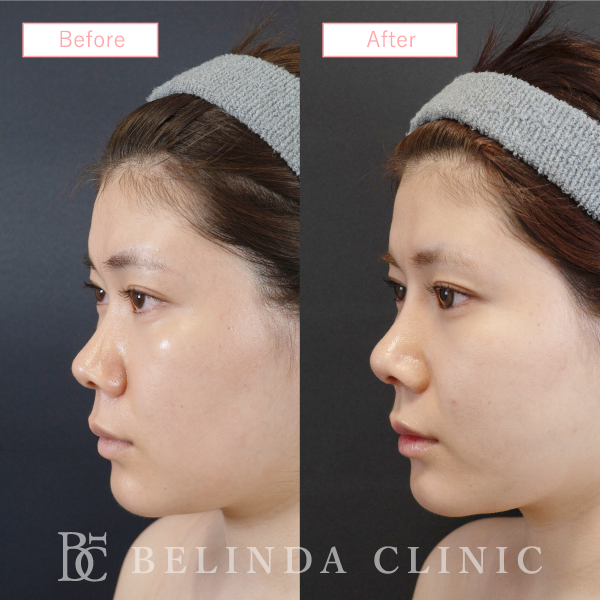 鼻プロテーゼ症例case15