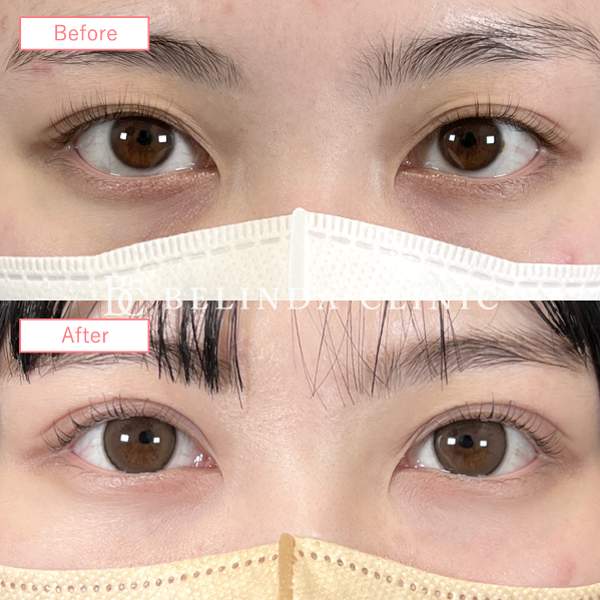 二重切開法法ビフォーアフターcase02