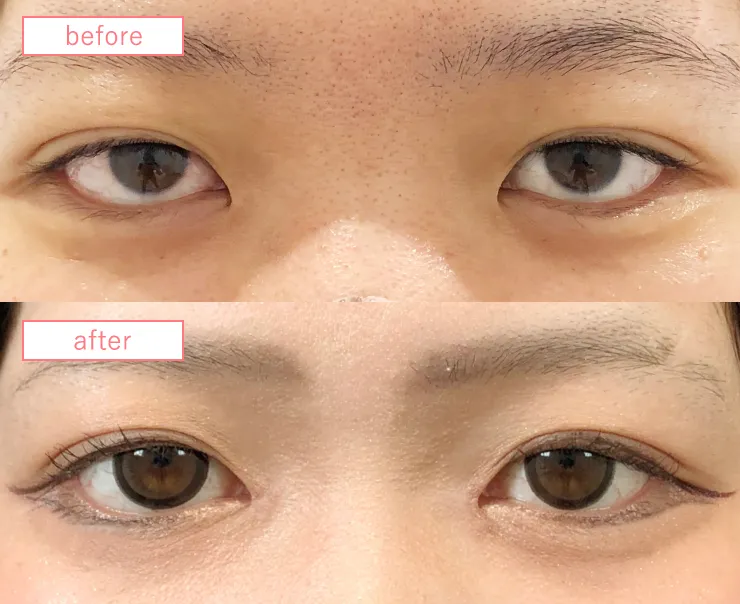 目頭切開ビフォーアフターcase02