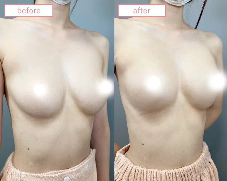 ヒアルロン酸豊胸症例