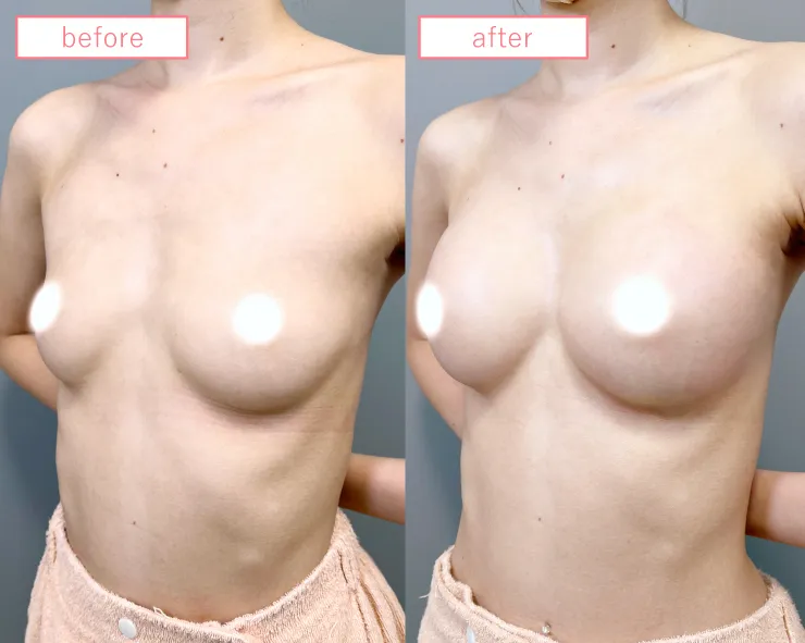 ヒアルロン酸豊胸症例