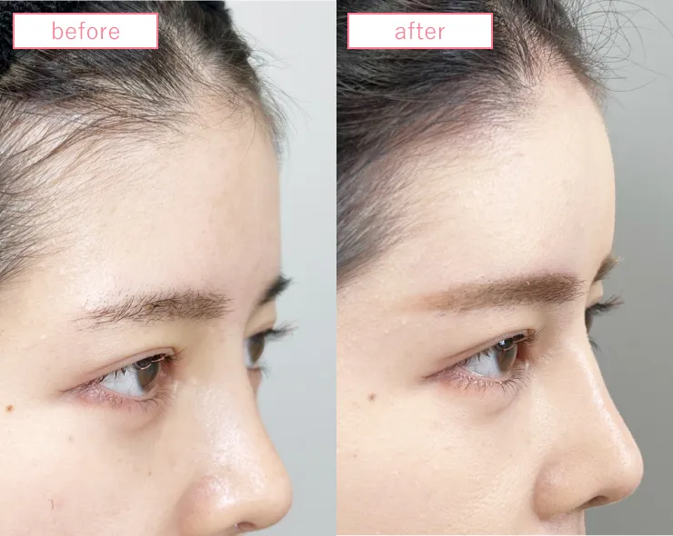 額ヒアルロン酸ビフォーアフターcase01