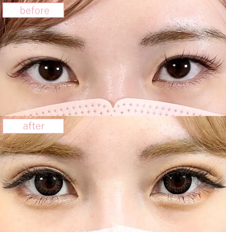 二重埋没法修正ビフォーアフターcase07