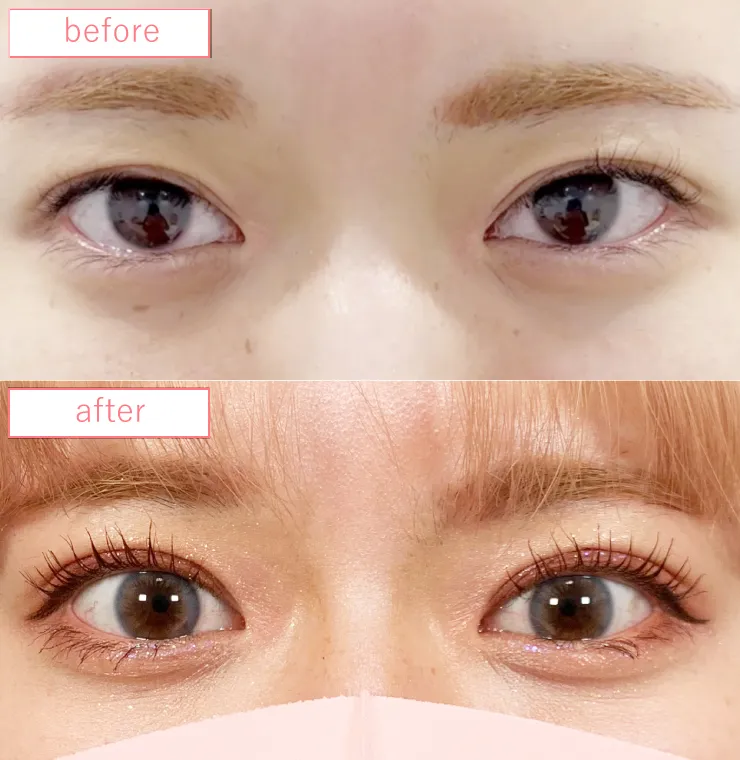 二重埋没法修正ビフォーアフターcase07