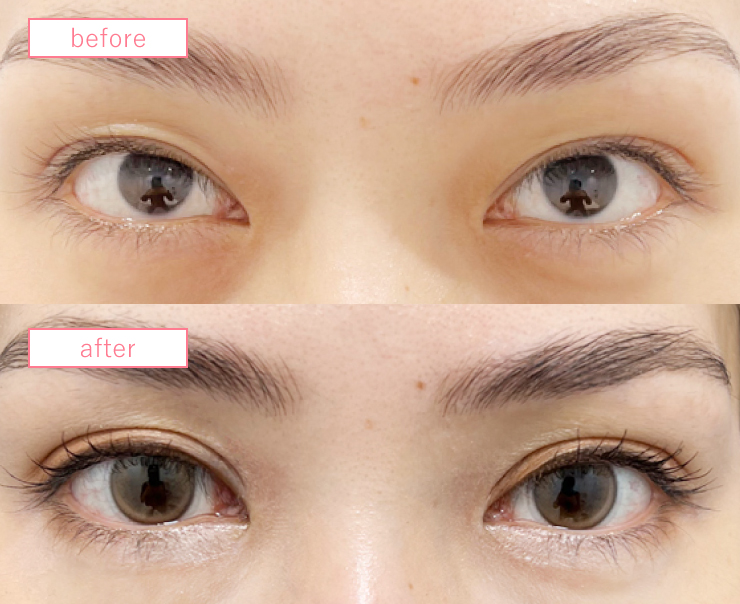 二重切開法法ビフォーアフターcase01