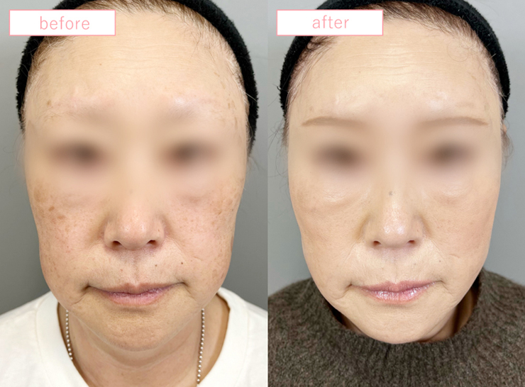 糸リフトビフォーアフターcase01