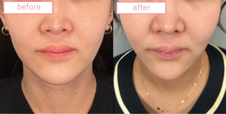 糸リフトビフォーアフターcase02