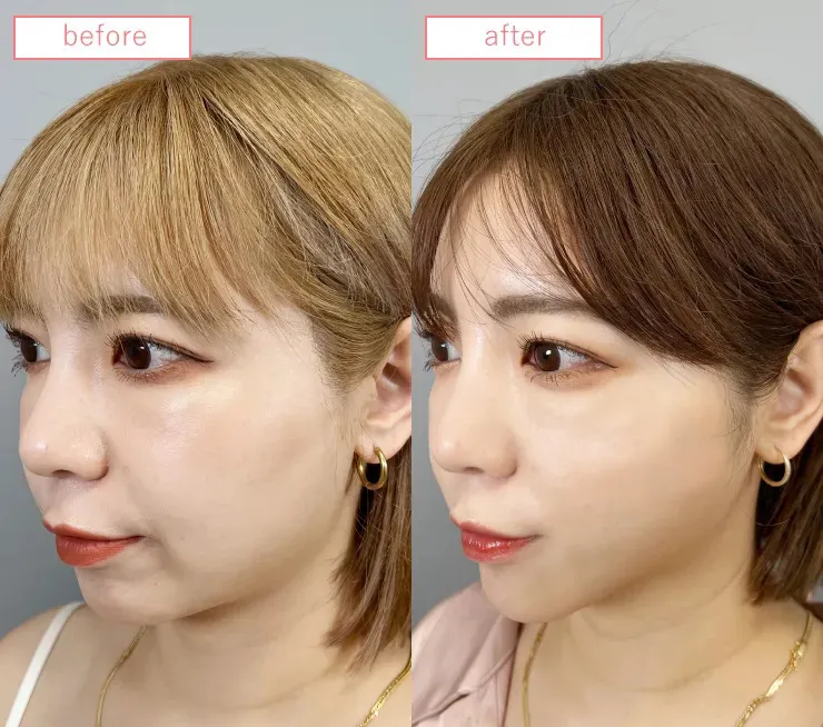 糸リフトビフォーアフターcase04