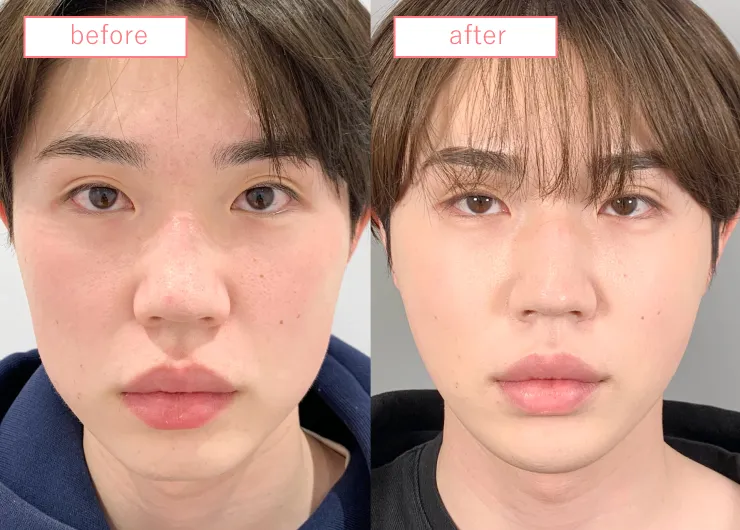 糸リフトビフォーアフターcase05