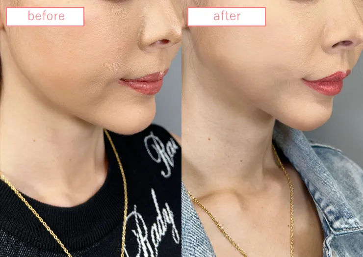 糸リフトビフォーアフターcase06