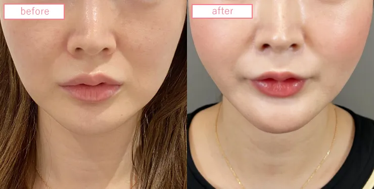 糸リフトビフォーアフターcase05