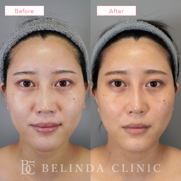 鼻尖縮小・鼻尖形成症例case08