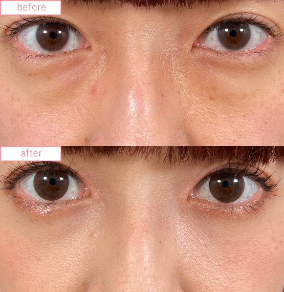 目の下の切らないクマ取りビフォーアフターcase02