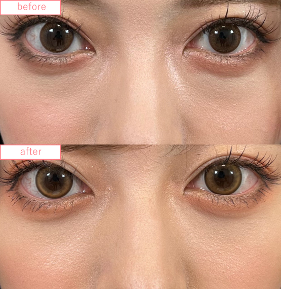 目の下の切らないクマ取りビフォーアフターcase06