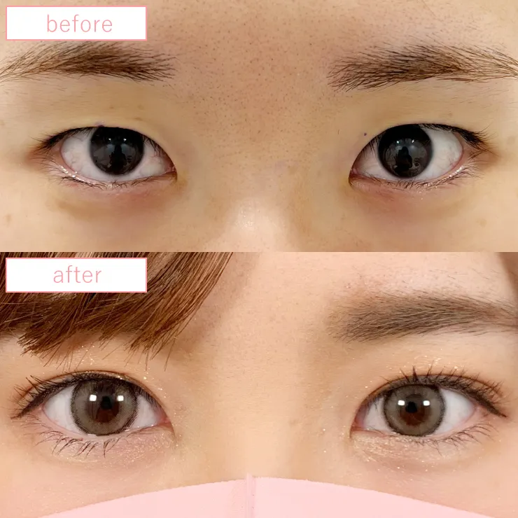 まぶたの脂肪取り症例ビフォーアフター02