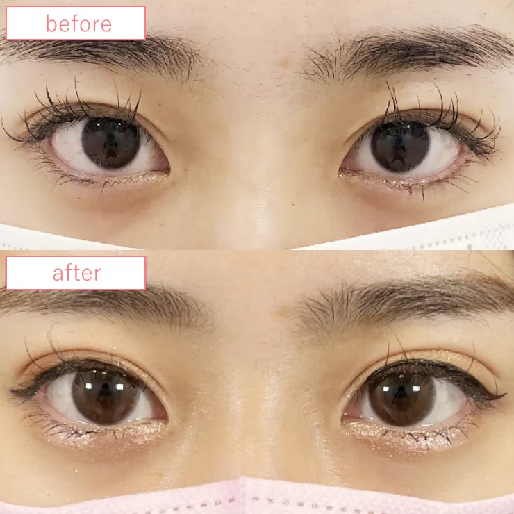 まぶたの脂肪取り症例ビフォーアフター03