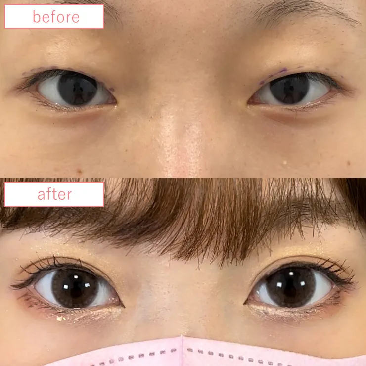 まぶたの脂肪取り症例ビフォーアフター04