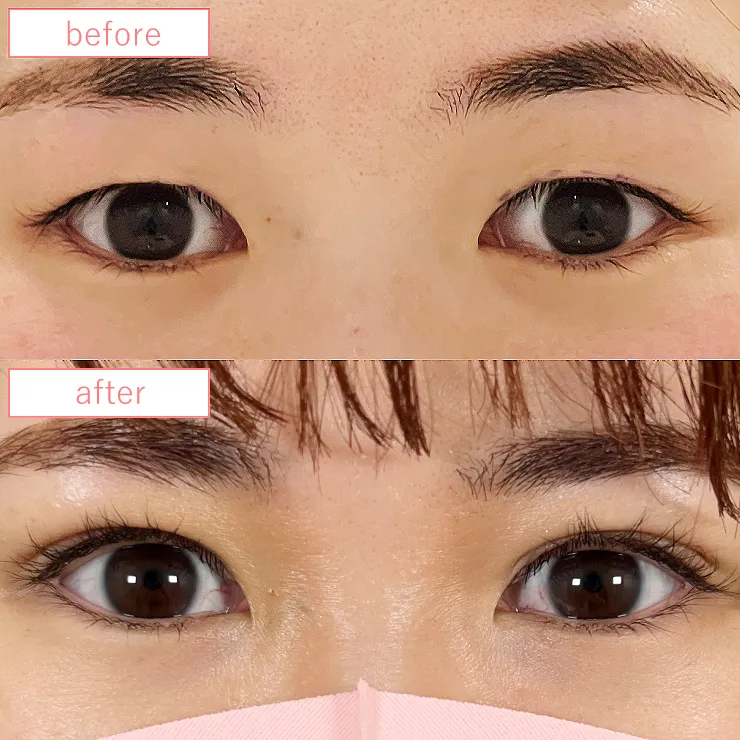 まぶたの脂肪取り症例ビフォーアフター05