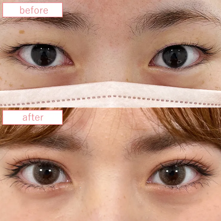 まぶたの脂肪取り症例ビフォーアフター06