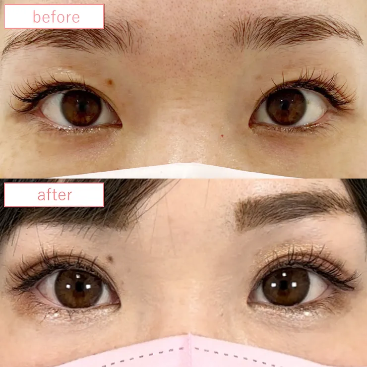 まぶたの脂肪取り症例ビフォーアフター07