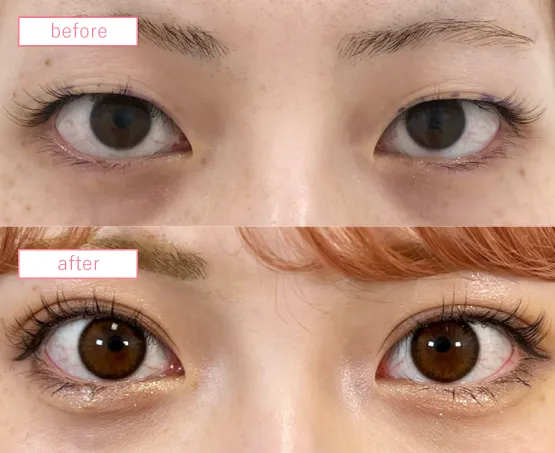 二重埋没法ビフォーアフターcase01