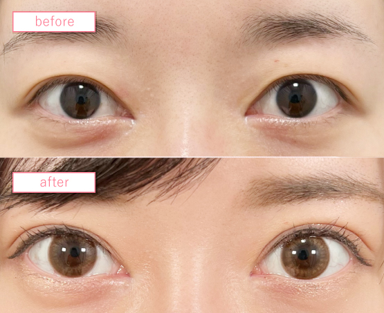 二重埋没法修正ビフォーアフターcase07