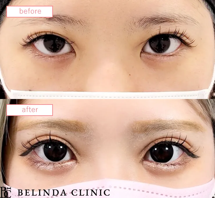 二重埋没法(他院修正)ビフォーアフターcase08