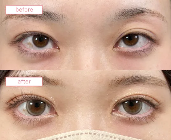 二重埋没法ビフォーアフター