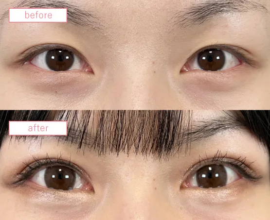 二重埋没法ビフォーアフター