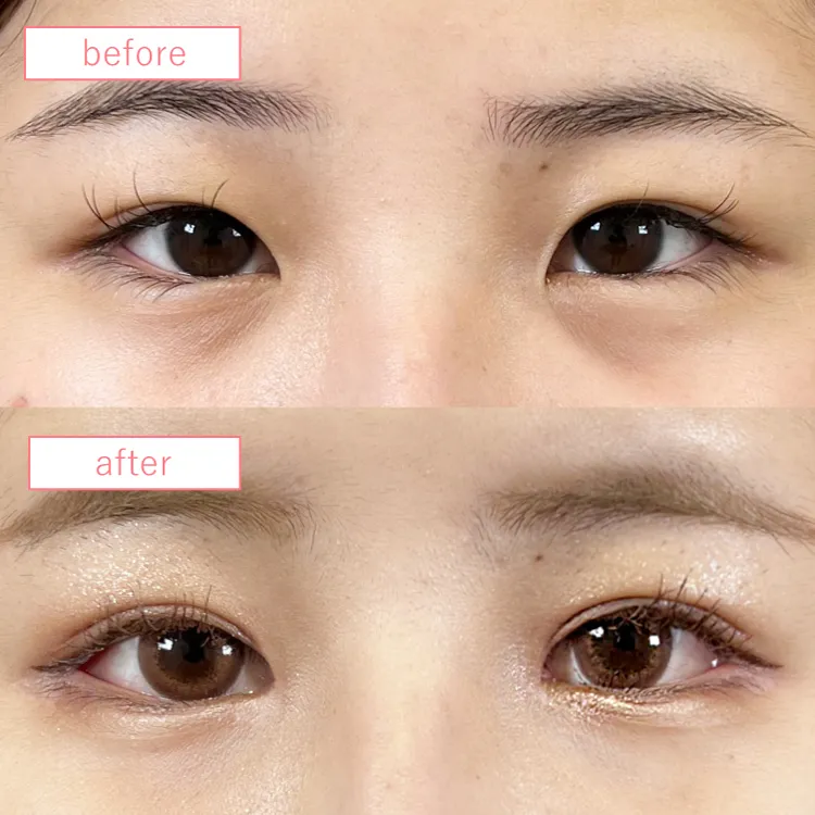 目上切開法ビフォーアフターcase01