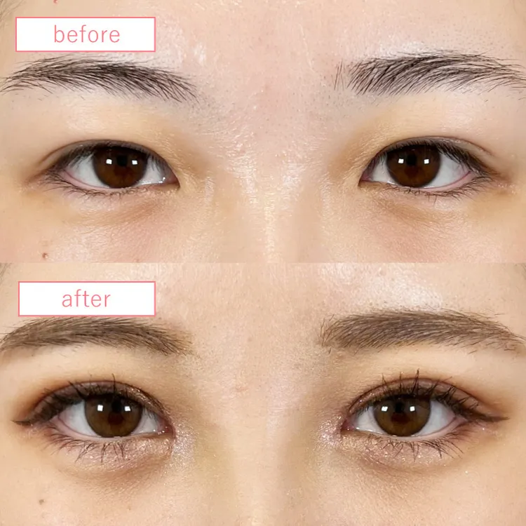 目上切開法ビフォーアフターcase02