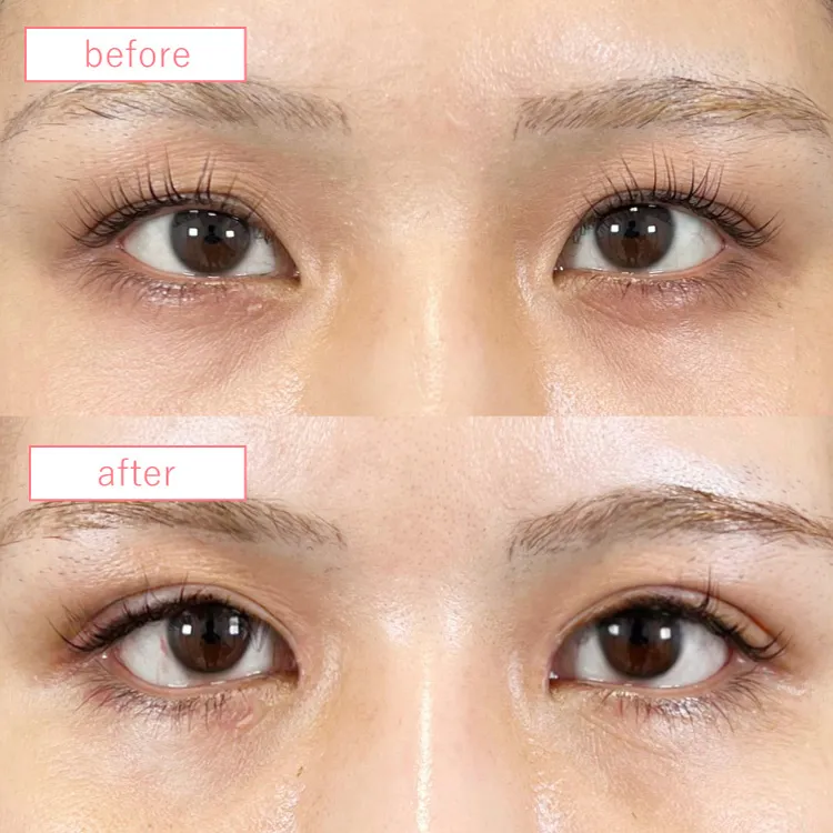 目上切開法ビフォーアフターcase03