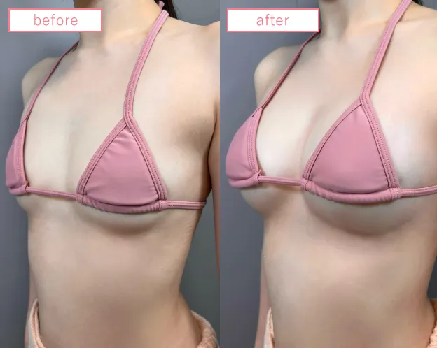 脂肪注入豊胸症例