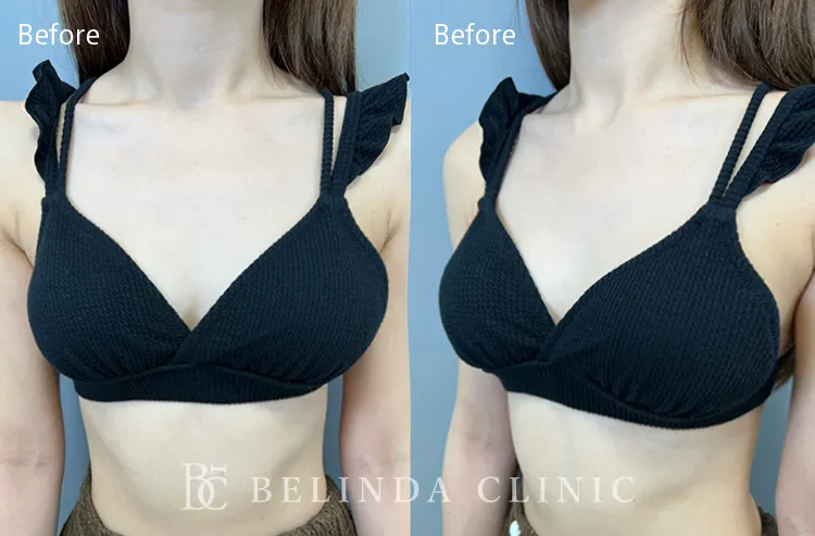 れいぽよちゃん豊胸before