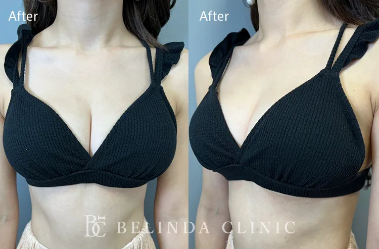 れいぽよちゃん豊胸after